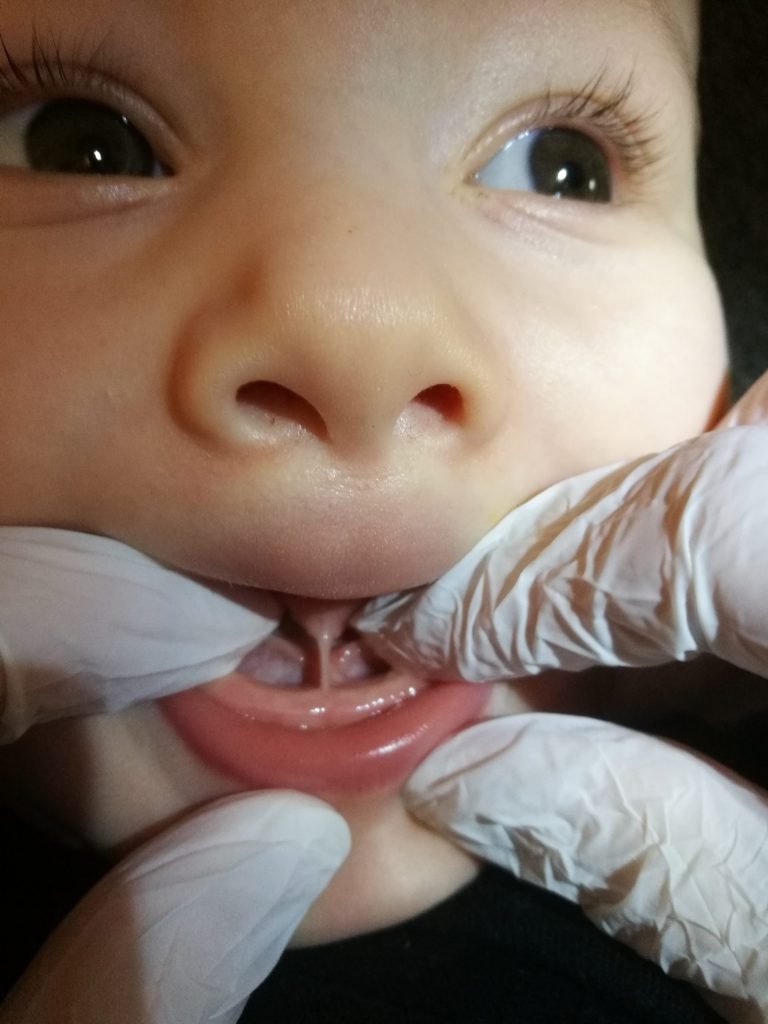 Tongue-tie assessment – Birth, Baby & You – Dee Bell – Lactation Consultant for Kent, Surrey & Sussex