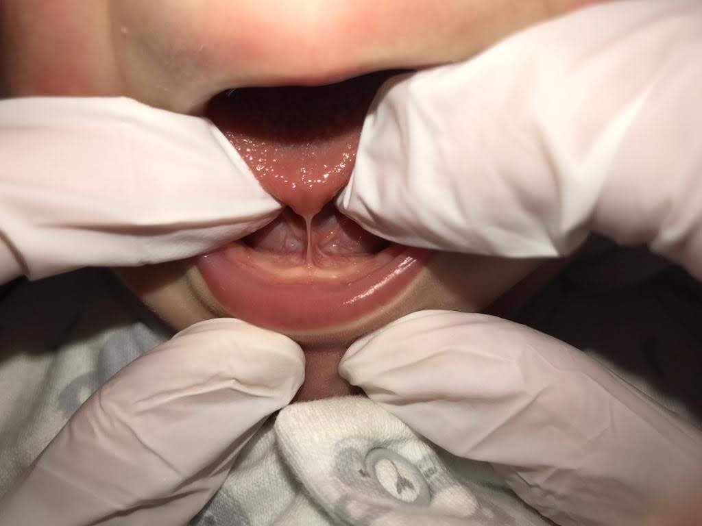 Anterior Tongue-tie – Birth, Baby & You – Dee Bell – Lactation Consultant for Kent, Surrey & Sussex